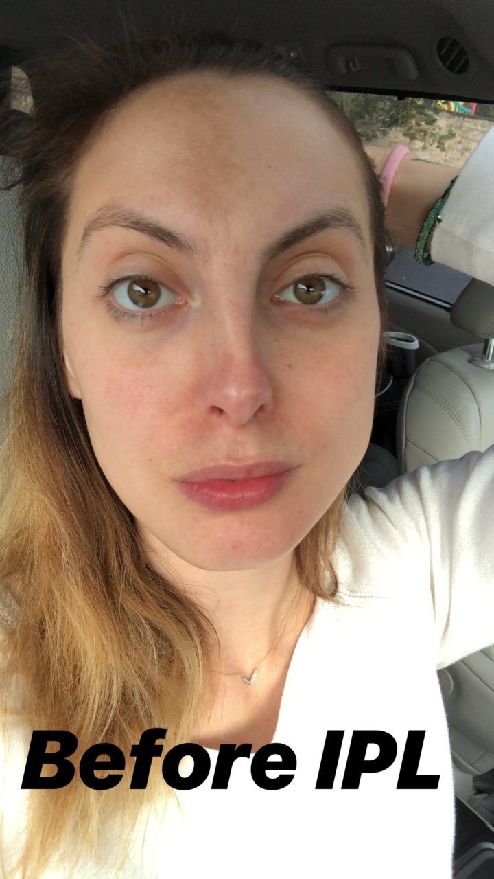 Eva Amurri Martino shares her struggle with post-pregnancy melasma spots and her solution for fading them.